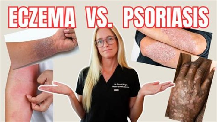 Eczema Meme: The Lighter Side of a Serious Skin Condition