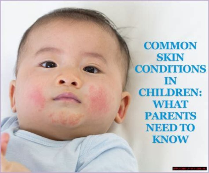 Eczema Memes: The Hilarious Side of a Common Skin Condition