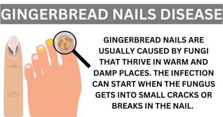 Gingerbread Fungus Nails: A Sweet-Spiced Solution for Your Nail Health