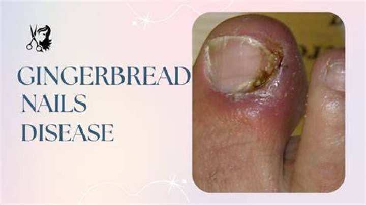 Gingerbread Fungus Nails Disease: A Sweet-Spiced Mystery Unveiled