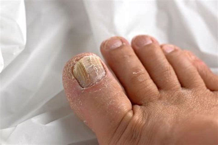 Gingerbread Nail Infection: A Sweet-Spiced Guide to Prevention and Treatment