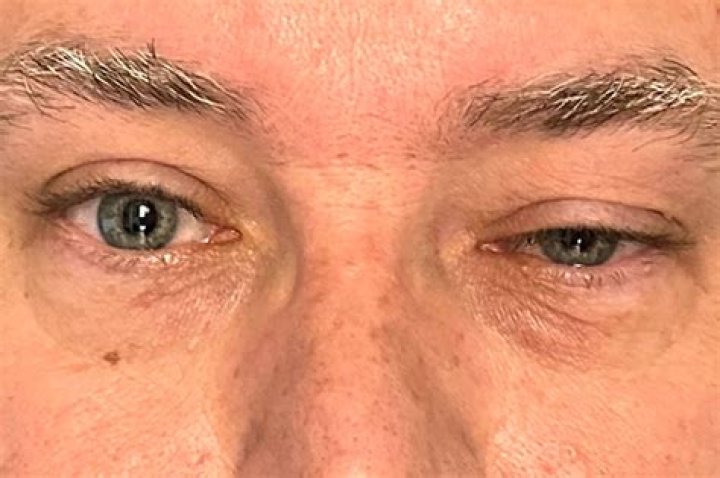 Steve Liesman Eye Injury Update: The Inside Story You Need to Know