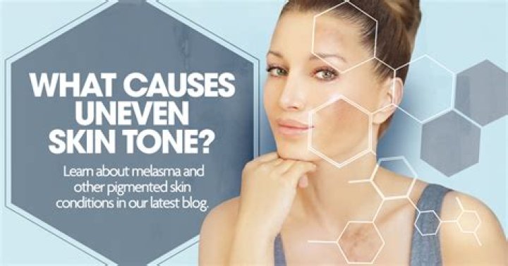 Why Does It Look Like I Have Uneven Skin Tone? A Deep Dive into the Causes and Solutions